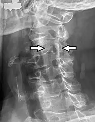 Oblique projectional radiograph of a man presenting with pain by the nape and left shoulder, showing a stenosis of the left intervertebral foramen of cervical spinal nerve 4, corresponding with the affected dermatome.