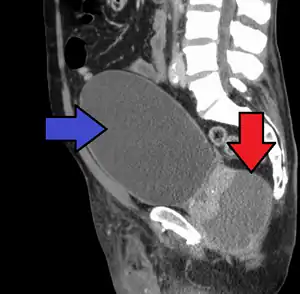 Abscess of the prostate (red arrow) resulting in urinary retention (blue arrow)