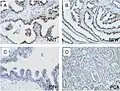 Microscopic examination of different types of prostate tissues (stained with immuno­histochemical techniques): A. Normal (non-neoplastic) prostatic tissue (NNT). B. Benign prostatic hyperplasia. C. High-grade prostatic intraepithelial neoplasia. D. Prostatic adenocarcinoma (PCA).