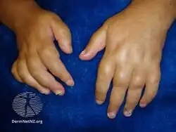 Swollen fingers due to psoriatic arthritis