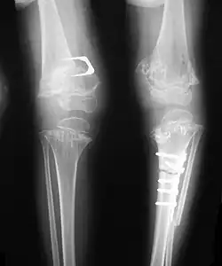 Pseudoachondroplasia. Leg radiographs depicting dysplastic distal femoral and proximal tibial epiphyses, and distal femoral metaphyseal broadening, cupping, irregularities (white arrows) and radiolucent areas especially medially. Note the metaphyseal line of ossification of the proximal tibias (blackarrows) and relative sparing of the tibial shafts. The  changes around the knee are known as "rachitic-like changes". Lesions are bilateral and symmetrical.