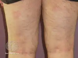 Psoriasis 6 months after commencing adalimumab
