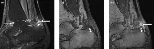 Sagittal magnetic resonance images of the ankle region in psoriatic arthritis. (a) Short tau inversion recovery (STIR) image, showing high signal intensity at the Achilles tendon insertion (enthesitis, thick arrow) and in the synovium of the ankle joint (synovitis, long thin arrow). Bone marrow edema is seen at the tendon insertion (short thin arrow). (b, c) T1 weighted images of a different section of the same patient, before (panel b) and after (panel c) intravenous contrast injection, confirm inflammation (large arrow) at the enthesis and reveal bone erosion at tendon insertion (short thin arrows).