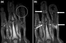 Magnetic resonance images of the fingers in psoriatic arthritis. Shown are T1-weighted (a) pre-contrast and (b) post-contrast coronal images. Enhancement of the synovial membrane at the third and fourth proximal interphalangeal (PIP) and distal interphalangeal (DIP) joints is seen, indicating active synovitis (inflammation of the synovial membrane; large arrows). There is joint space narrowing with bone proliferation at the third PIP joint and erosions are present at the fourth DIP joint (white circle). Extracapsular enhancement (small arrows) is seen medial to the third and fourth PIP joints, indicating probable enthesitis (inflammation of a tendon insertion).