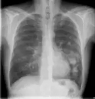 Chest X-ray of lungs affected by cryptococcosis