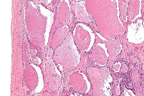Intermediate magnification micrograph of pulmonary alveolar proteinosis. H&E stain.