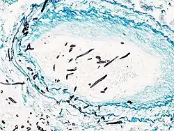 Angioinvasive pulmonary aspergillosis