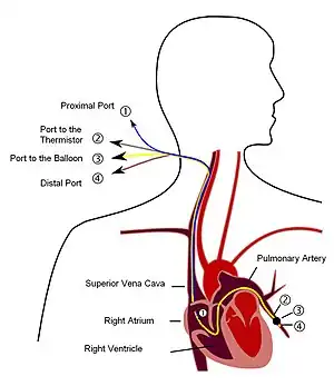 Pulmonary artery catheter