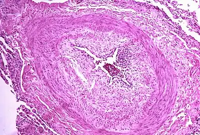 Micrograph showing arteries in pulmonary hypertensive with marked thickening of the walls.