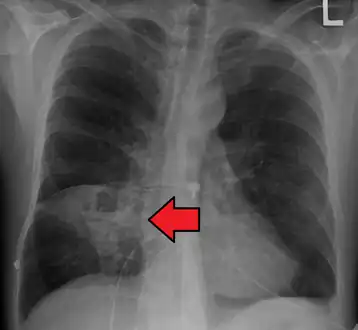 Pulmonary abscess on CXR