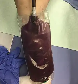 A urine bag containing purple liquid
