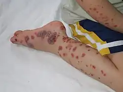 More severe case of HSP on child's foot, leg, and arm