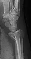 Lateral projectional radiograph of the same fracture