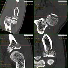 CT scan showing a radial head fracture