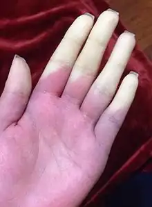 Raynaud's affecting all five fingers