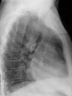 Chest radiograph showing a right-sided aortic arch, lateral view