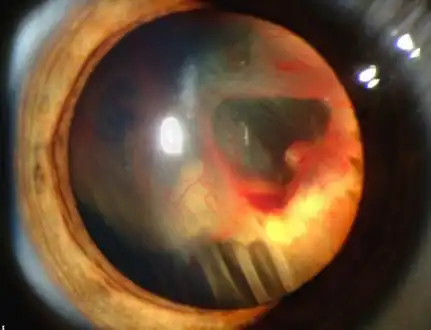 Slit lamp photograph showing retinal detachment in Von Hippel–Lindau disease