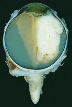 Large exophytic white tumor with foci of calcification producing total exudative retinal detachment