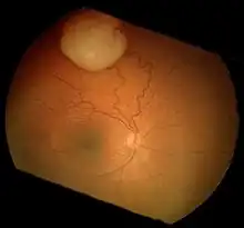 Funduscopic finding of a retinoblastoma