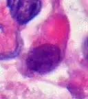 Rhabdoid Tumor Cell - 400X Magnification