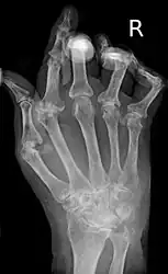 X-ray of the hand in rheumatoid arthritis.