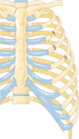 Illustration showing rib fracture at 3rd, 4th and 5th rib.