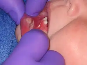 Solitary, large, white to yellow erosion on the inner lower lip of a child