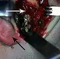 Rigid internal fixation of right condyle fracture with mini-plate on the neck of the condyle.  Black arrow marks right earlobe, white arrow marks head of the condyle