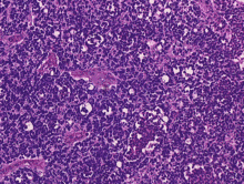 Retinoblastoma, 400 X magnification