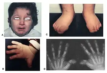 Facial features (A), left hand and feet showing broad thumb and big toes (B, C) and X-ray of both hands showing short broad thumbs (D). (Limb Malformations & Skeletal Dysplasia)