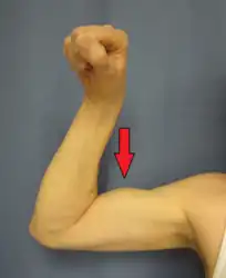 Rupture of the long head of the proximal biceps. Note muscle appears larger.