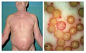 Sézary syndrome in a 61-year-old man presenting in 1972 with unrelenting itchiness of six months’ duration. On the right is his peripheral blood film stained with Periodic Acid-Schiff (PAS) showing a neoplastic T cell (Sézary cell).