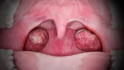 A medical animation still that shows Tonsillitis.