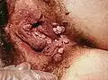 Severe case of external genital warts on a female