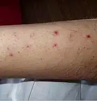 Numerous spots of bleeding into the skin of the leg in a person infected with T. b. rhodesiense