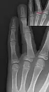 Salter–Harris II fracture of ring finger proximal phalanx.