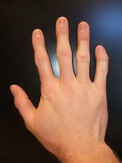 The type of finger curvature frequently seen in triple X syndrome