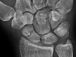 Radiolucency around a 12 days old scaphoid fracture that was initially barely visible.