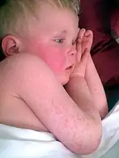 Facial flushing and classic rash of scarlet fever in light skin