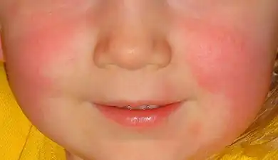 Red cheeks and pale area around the mouth in scarlet fever