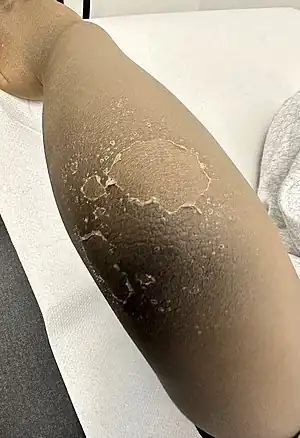 Skin peeling at elbow