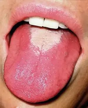 White coating sheds: strawberry tongue