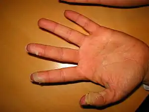Peeling of finger tip skin