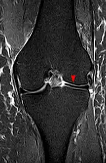Discoid meniscus on coronal proton-density weighted MRI