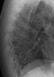 Scheuermann's disease on lateral Xray of the T spine