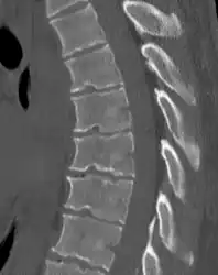 Scheuermann's disease on lateral CT of the T spine