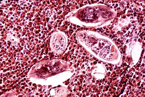 High-powered detailed micrograph of Schistosoma parasite eggs in human bladder tissue