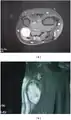 MRI showing schwannoma of ulna nerve