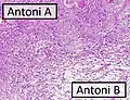 Micrograph of a schwannoma showing both a cellular Antoni A area (top) and a loose paucicellular Antoni B area (bottom). HE stain.