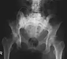 X-ray: Bone cancer in hip, spread from breast cancer.